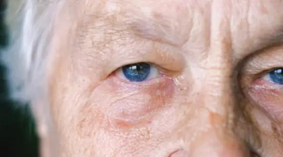 Les maladies neurod&eacute;g&eacute;n&eacute;ratives Image 1
